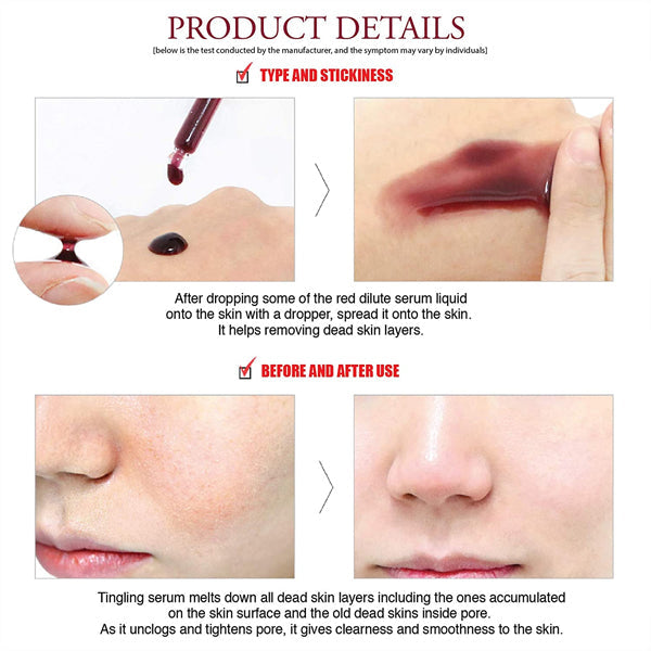 [so natural] Red Peel Tingle Serum 35ml [US, Japan, Germany, India, UK, Uae, France, Italy, Brazil, Canada, Russia, South Africa, Australia, Kuwait, Mexico, Indonesia, Netherlands, Saudi Arabia, UKRAIN, Finland, POLAND, Singapore, Malaysia ]